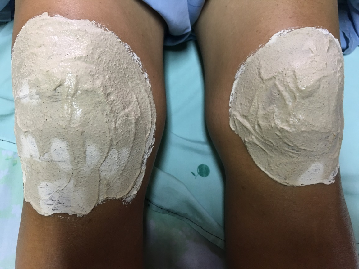 พอกเข่า